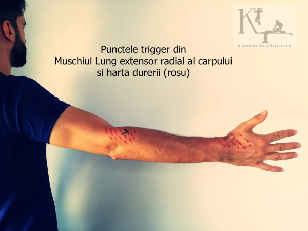 puncte trigger muschi lung extensor radial al carpului si harta durerii