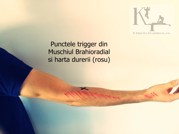 puncte trigger muschi brahioradial si harta durerii