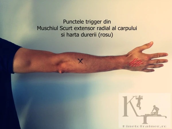puncte trigger muschi scurt extensor radial al carpului si harta durerii