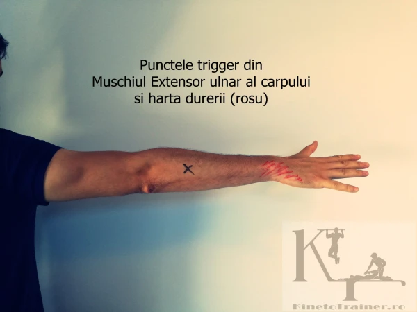 puncte trigger muschi extensor ulnar al carpului si harta durerii