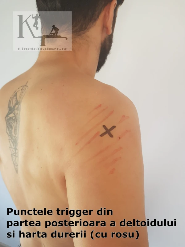 puncte trigger partea posterioara