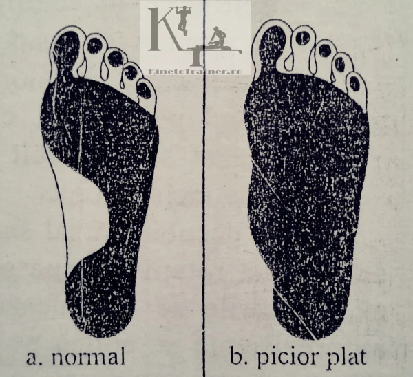 imagine desen amprenta plantara diferente intre piciorul normal si piciorul plat