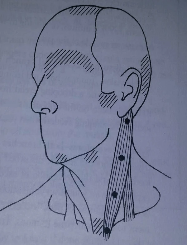 imagine desen pucte trigger muschi sternocleidomastoidian ramura sternala