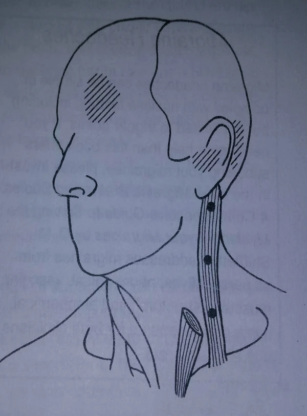 puncte trigger muschi sternocleidomastoidian ramura claviculara