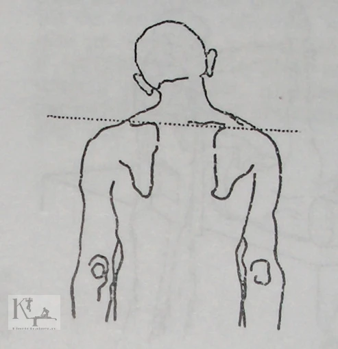 desen torticolis congenital