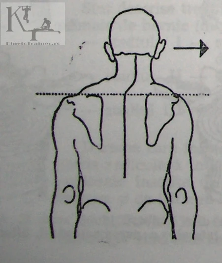 desen torticolis redresat printr-o scolioza cervicala